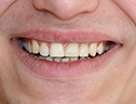 зубы после имплантации