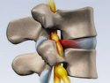 Лечение грыжи позвоночника - межпозвоночная грыжа