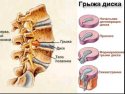 Лечение грыжи позвоночника - межпозвоночная грыжа